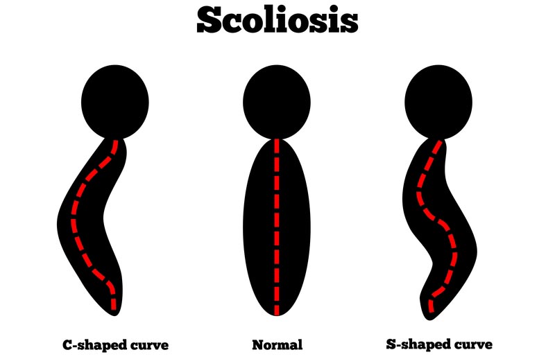 Reno, NC scoliosis treatment
